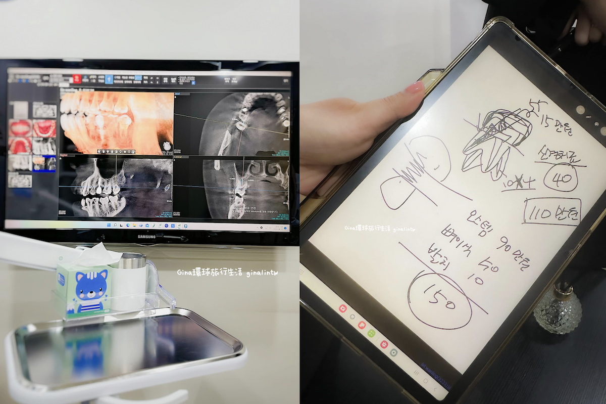 首爾牙科植牙初體驗｜韓國植牙價格！超痛韓國牙科經驗分享 @GINA環球旅行生活